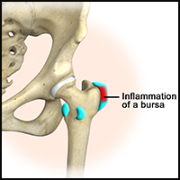 Hip Bursitis Treatment Houston  Trochanteric & Iliopsoas Bursa Treatment  Houston